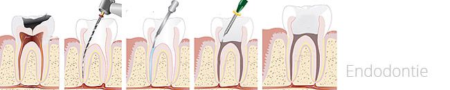Wurzelkanalbehandlung